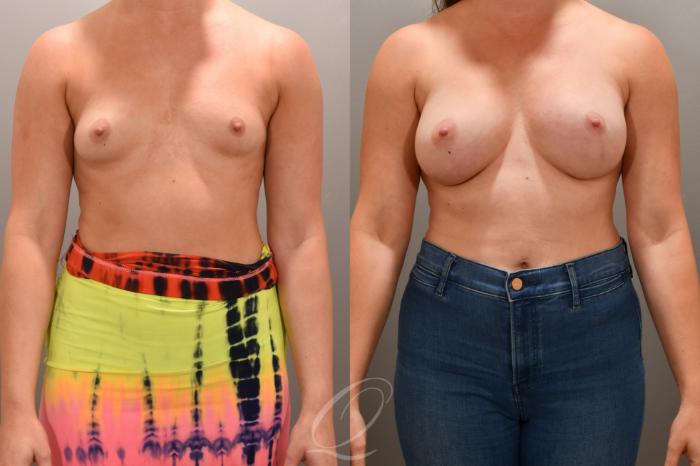 Breast Augmentation Case 1001657 Before & After Front | Serving Rochester, Syracuse & Buffalo, NY | Quatela Center for Plastic Surgery
