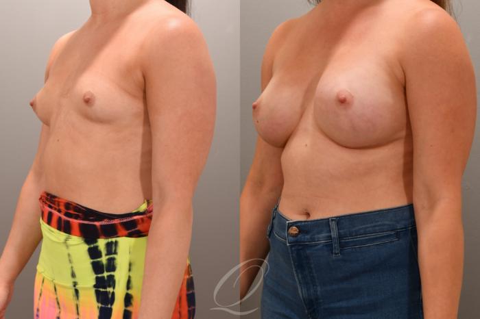 Breast Augmentation Case 1001657 Before & After Left Oblique | Serving Rochester, Syracuse & Buffalo, NY | Quatela Center for Plastic Surgery