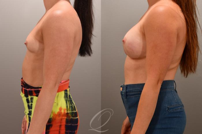 Breast Augmentation Case 1001657 Before & After Left Side | Serving Rochester, Syracuse & Buffalo, NY | Quatela Center for Plastic Surgery