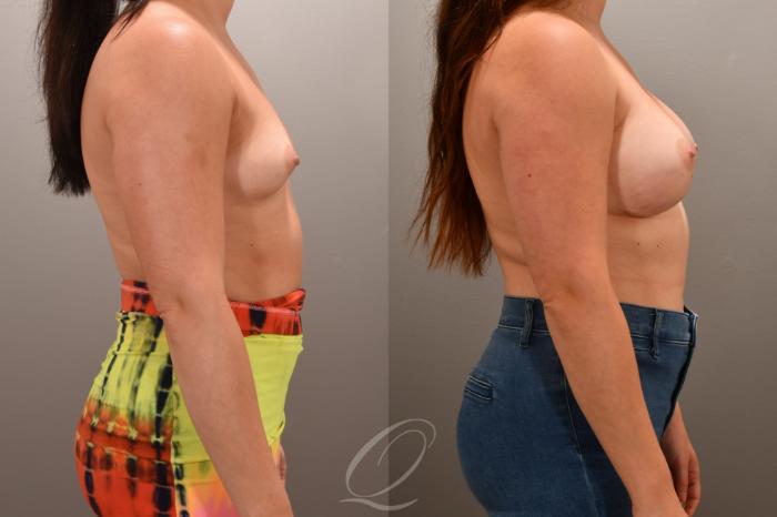 Breast Augmentation Case 1001657 Before & After Right Side | Serving Rochester, Syracuse & Buffalo, NY | Quatela Center for Plastic Surgery