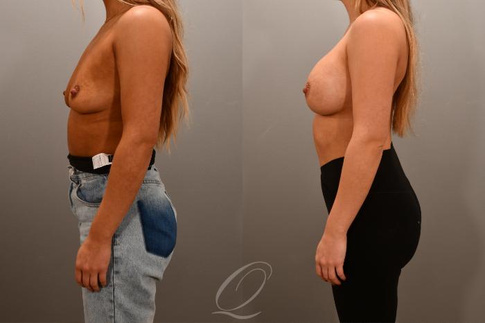 Breast Augmentation Case 1001666 Before & After Left Side | Serving Rochester, Syracuse & Buffalo, NY | Quatela Center for Plastic Surgery