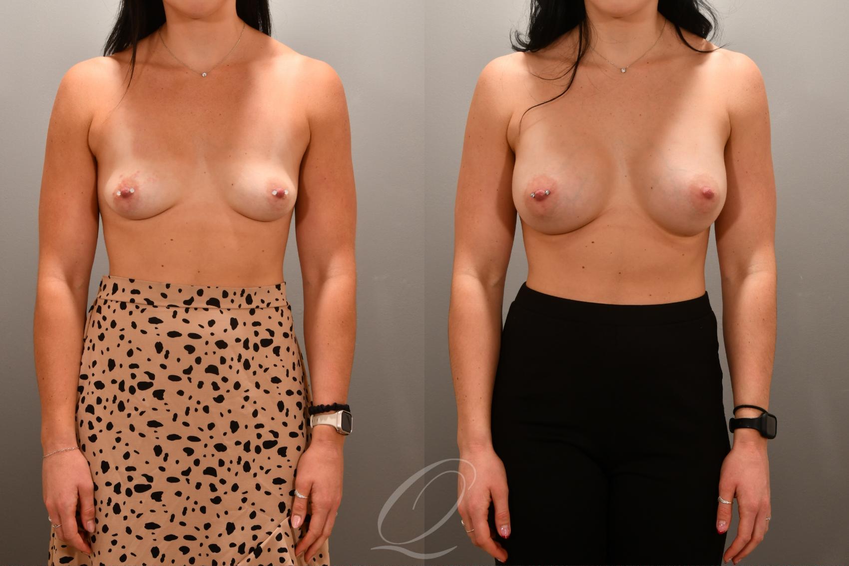 Breast Augmentation Case 1001667 Before & After Front | Serving Rochester, Syracuse & Buffalo, NY | Quatela Center for Plastic Surgery