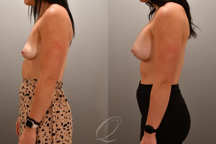 Breast Augmentation Case 1001667 Before & After Left Side | Serving Rochester, Syracuse & Buffalo, NY | Quatela Center for Plastic Surgery