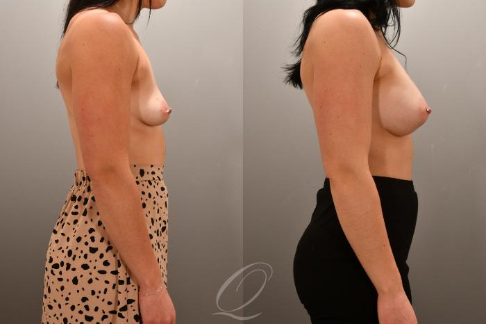 Breast Augmentation Case 1001667 Before & After Right Side | Serving Rochester, Syracuse & Buffalo, NY | Quatela Center for Plastic Surgery