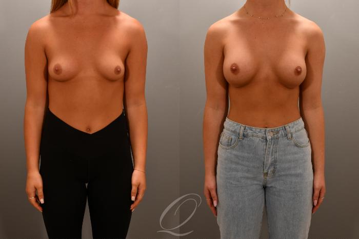 Breast Augmentation Case 1001668 Before & After Front | Serving Rochester, Syracuse & Buffalo, NY | Quatela Center for Plastic Surgery