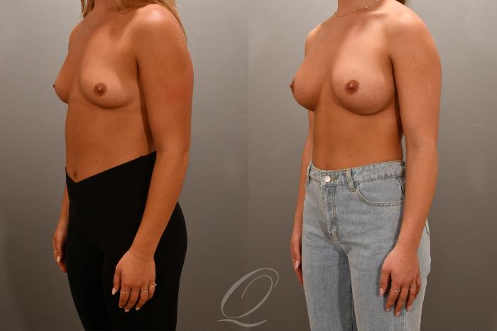 Breast Augmentation Case 1001668 Before & After Left Oblique | Serving Rochester, Syracuse & Buffalo, NY | Quatela Center for Plastic Surgery