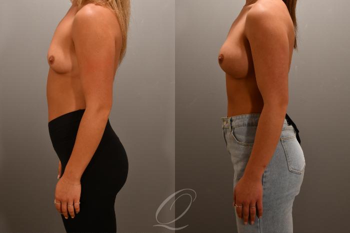 Breast Augmentation Case 1001668 Before & After Left Side | Serving Rochester, Syracuse & Buffalo, NY | Quatela Center for Plastic Surgery