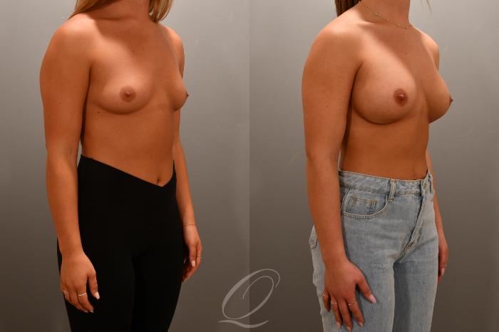 Breast Augmentation Case 1001668 Before & After Right Oblique | Serving Rochester, Syracuse & Buffalo, NY | Quatela Center for Plastic Surgery