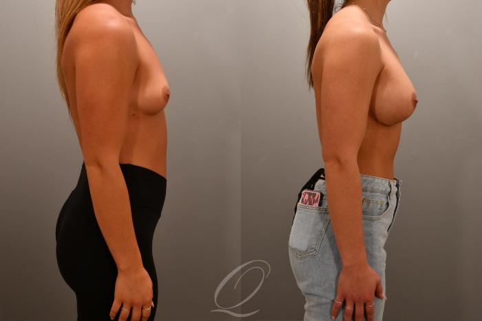 Breast Augmentation Case 1001668 Before & After Right Side | Serving Rochester, Syracuse & Buffalo, NY | Quatela Center for Plastic Surgery