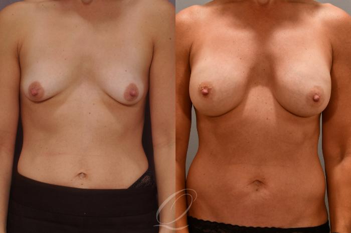Breast Augmentation Case 1001681 Before & After Front | Serving Rochester, Syracuse & Buffalo, NY | Quatela Center for Plastic Surgery
