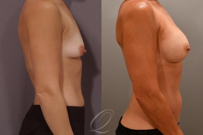 Breast Augmentation Case 1001681 Before & After Right Side | Serving Rochester, Syracuse & Buffalo, NY | Quatela Center for Plastic Surgery