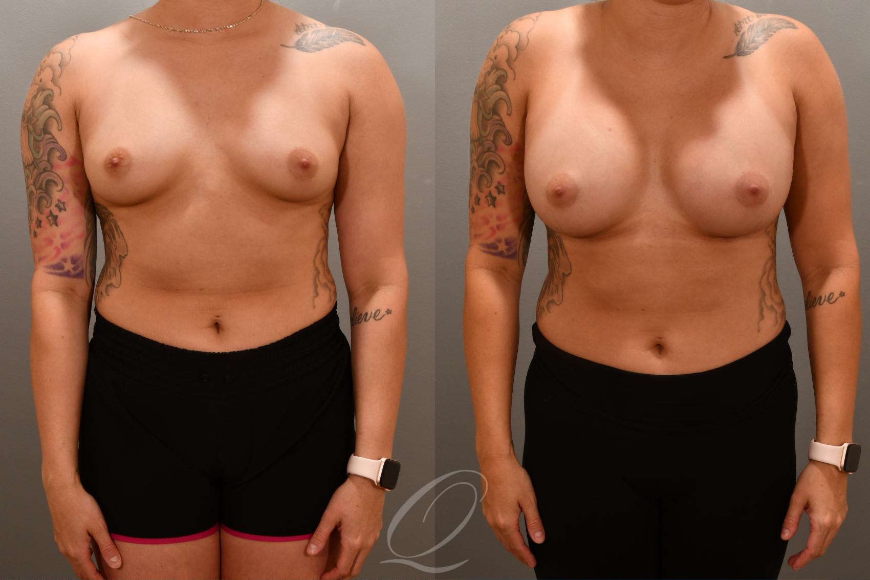 Breast Augmentation Case 1001682 Before & After Front | Serving Rochester, Syracuse & Buffalo, NY | Quatela Center for Plastic Surgery