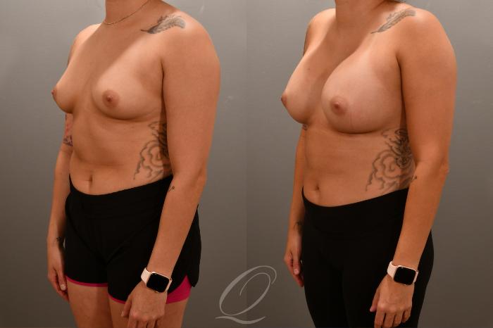Breast Augmentation Case 1001682 Before & After Left Oblique | Serving Rochester, Syracuse & Buffalo, NY | Quatela Center for Plastic Surgery