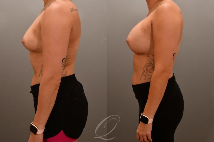 Breast Augmentation Case 1001682 Before & After Left Side | Serving Rochester, Syracuse & Buffalo, NY | Quatela Center for Plastic Surgery