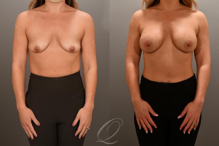 Breast Augmentation Case 1001687 Before & After Front | Serving Rochester, Syracuse & Buffalo, NY | Quatela Center for Plastic Surgery