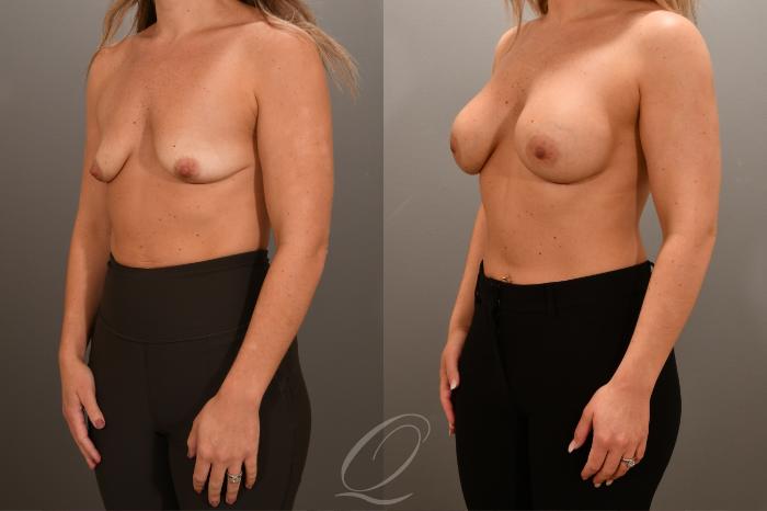 Breast Augmentation Case 1001687 Before & After Left Oblique | Serving Rochester, Syracuse & Buffalo, NY | Quatela Center for Plastic Surgery