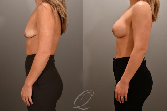 Breast Augmentation Case 1001687 Before & After Left Side | Serving Rochester, Syracuse & Buffalo, NY | Quatela Center for Plastic Surgery