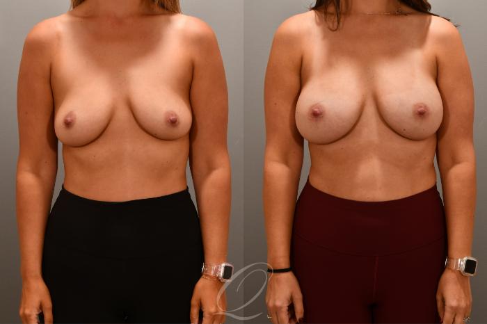 Breast Augmentation Case 1001701 Before & After Front | Serving Rochester, Syracuse & Buffalo, NY | Quatela Center for Plastic Surgery