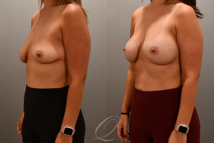 Breast Augmentation Case 1001701 Before & After Left Oblique | Serving Rochester, Syracuse & Buffalo, NY | Quatela Center for Plastic Surgery