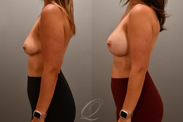 Breast Augmentation Case 1001701 Before & After Left Side | Serving Rochester, Syracuse & Buffalo, NY | Quatela Center for Plastic Surgery