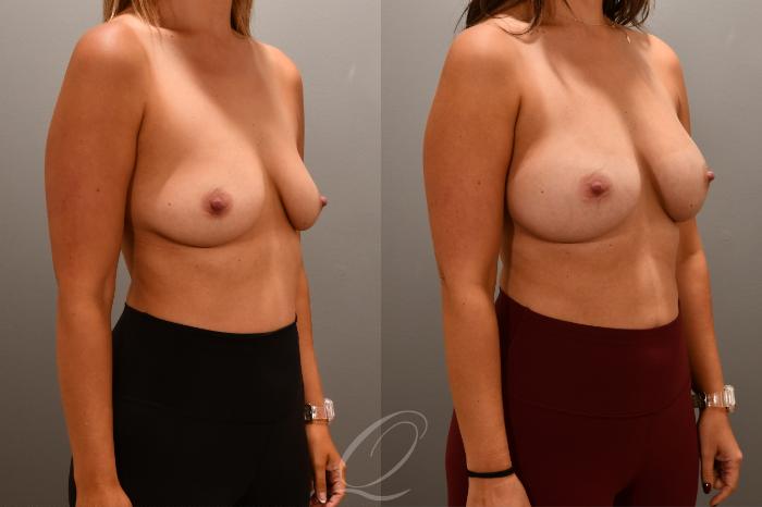 Breast Augmentation Case 1001701 Before & After Right Oblique | Serving Rochester, Syracuse & Buffalo, NY | Quatela Center for Plastic Surgery
