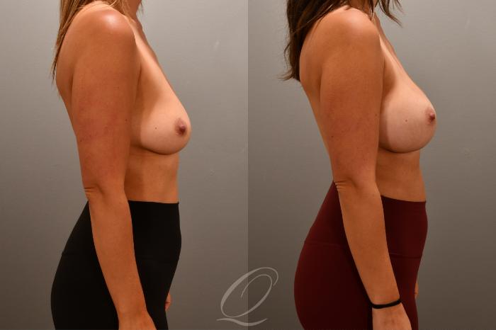 Breast Augmentation Case 1001701 Before & After Right Side | Serving Rochester, Syracuse & Buffalo, NY | Quatela Center for Plastic Surgery