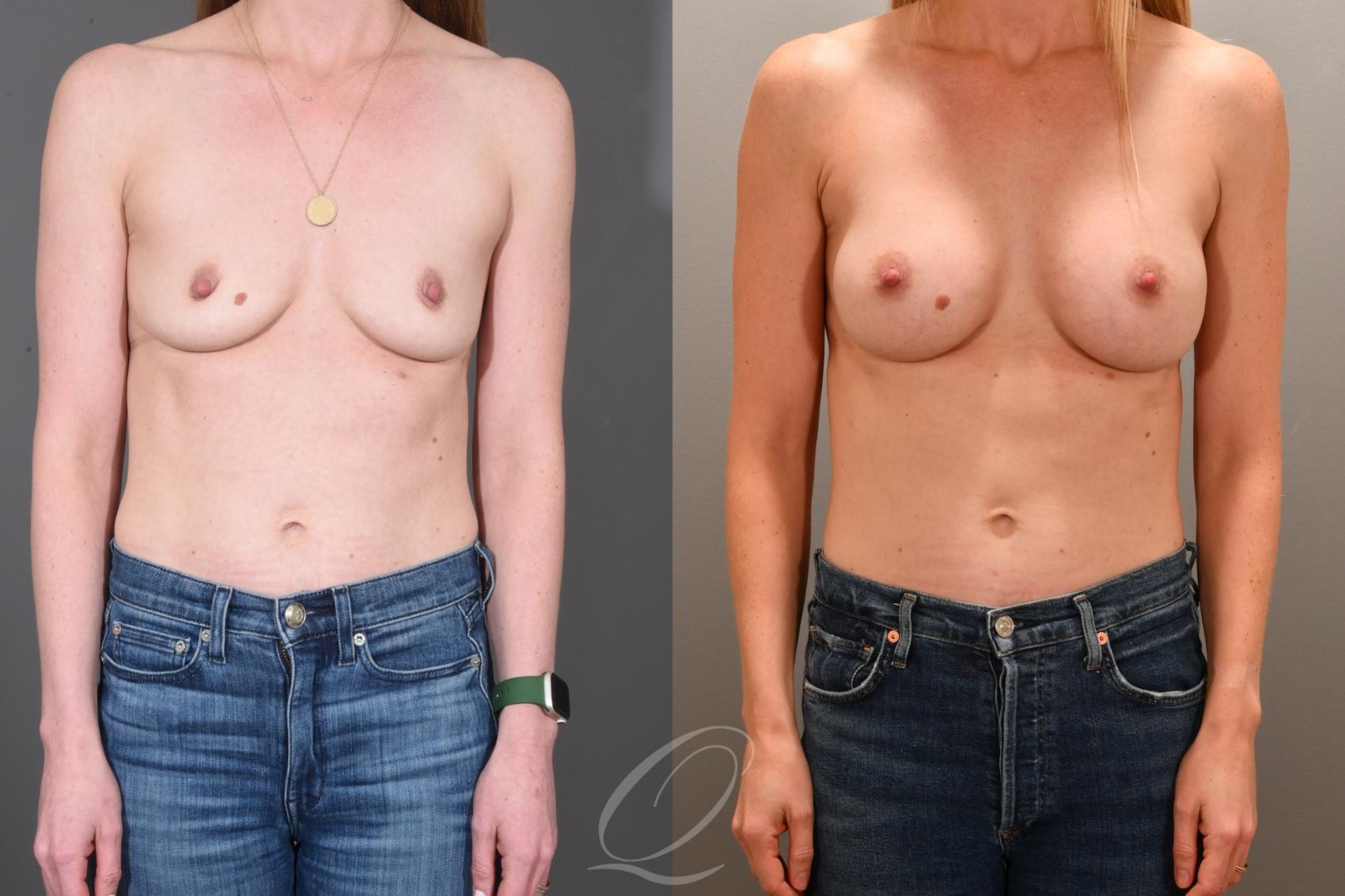 Breast Augmentation Case 1001702 Before & After Front | Serving Rochester, Syracuse & Buffalo, NY | Quatela Center for Plastic Surgery