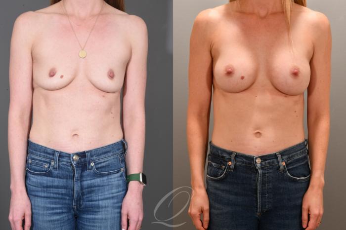 Breast Augmentation Case 1001702 Before & After Front | Serving Rochester, Syracuse & Buffalo, NY | Quatela Center for Plastic Surgery