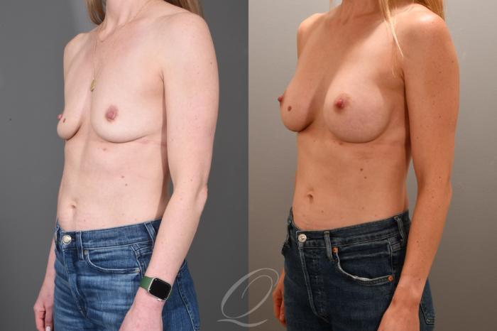 Breast Augmentation Case 1001702 Before & After Left Oblique | Serving Rochester, Syracuse & Buffalo, NY | Quatela Center for Plastic Surgery