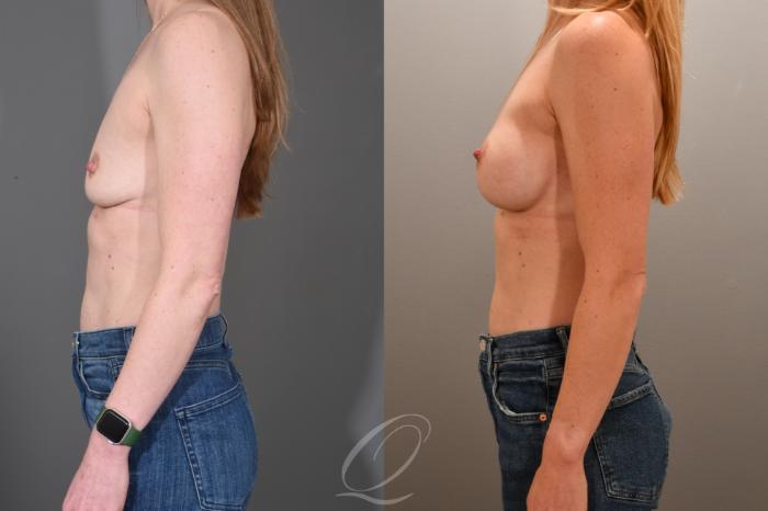Breast Augmentation Case 1001702 Before & After Left Side | Serving Rochester, Syracuse & Buffalo, NY | Quatela Center for Plastic Surgery