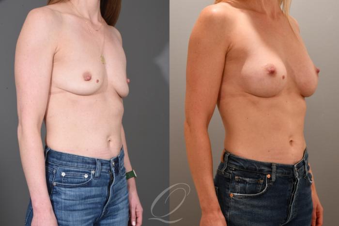 Breast Augmentation Case 1001702 Before & After Right Oblique | Serving Rochester, Syracuse & Buffalo, NY | Quatela Center for Plastic Surgery