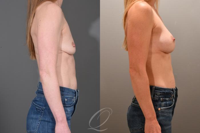 Breast Augmentation Case 1001702 Before & After Right Side | Serving Rochester, Syracuse & Buffalo, NY | Quatela Center for Plastic Surgery