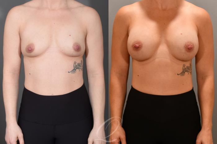Breast Augmentation Case 1001703 Before & After Front | Serving Rochester, Syracuse & Buffalo, NY | Quatela Center for Plastic Surgery