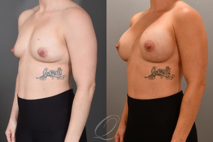Breast Augmentation Case 1001703 Before & After Left Oblique | Serving Rochester, Syracuse & Buffalo, NY | Quatela Center for Plastic Surgery