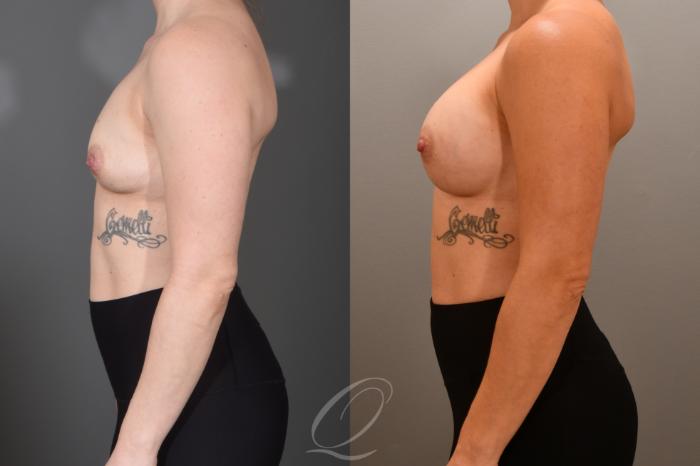 Breast Augmentation Case 1001703 Before & After Left Side | Serving Rochester, Syracuse & Buffalo, NY | Quatela Center for Plastic Surgery