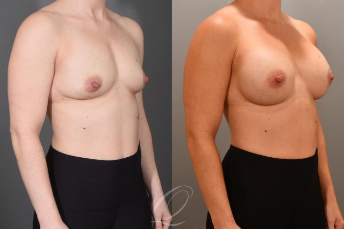Breast Augmentation Case 1001703 Before & After Right Oblique | Serving Rochester, Syracuse & Buffalo, NY | Quatela Center for Plastic Surgery