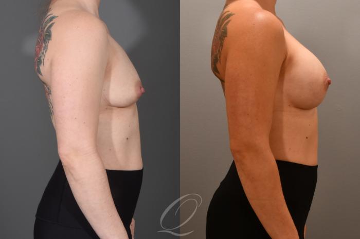 Breast Augmentation Case 1001703 Before & After Right Side | Serving Rochester, Syracuse & Buffalo, NY | Quatela Center for Plastic Surgery