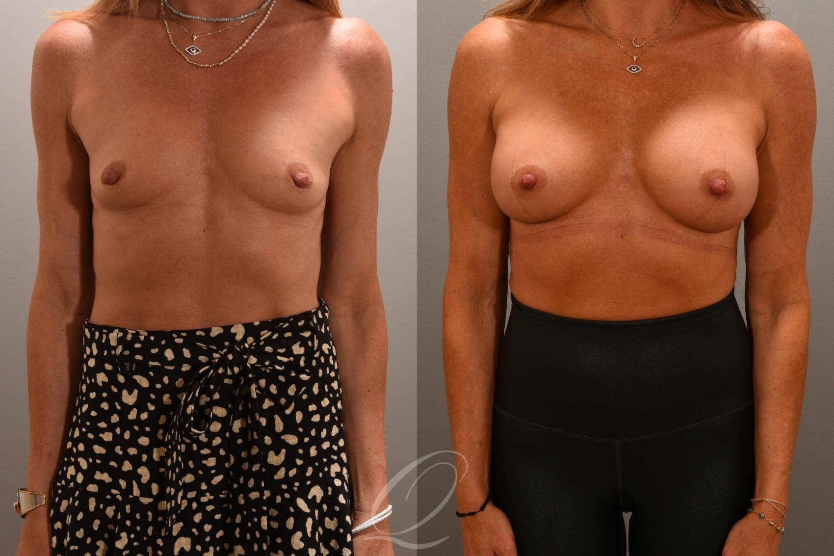 Breast Augmentation Case 1001704 Before & After Front | Serving Rochester, Syracuse & Buffalo, NY | Quatela Center for Plastic Surgery