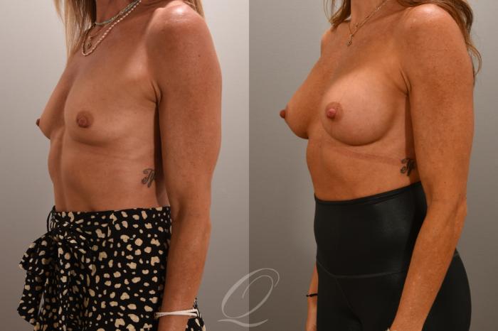 Breast Augmentation Case 1001704 Before & After Left Oblique | Serving Rochester, Syracuse & Buffalo, NY | Quatela Center for Plastic Surgery