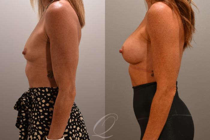 Breast Augmentation Case 1001704 Before & After Left Side | Serving Rochester, Syracuse & Buffalo, NY | Quatela Center for Plastic Surgery