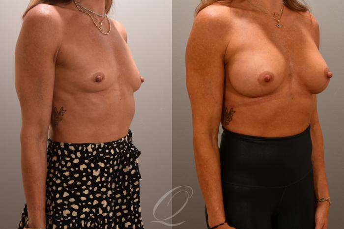 Breast Augmentation Case 1001704 Before & After Right Oblique | Serving Rochester, Syracuse & Buffalo, NY | Quatela Center for Plastic Surgery