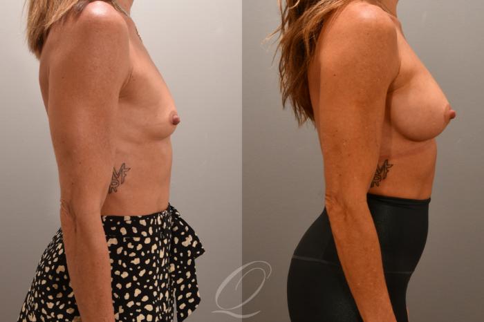 Breast Augmentation Case 1001704 Before & After Right Side | Serving Rochester, Syracuse & Buffalo, NY | Quatela Center for Plastic Surgery