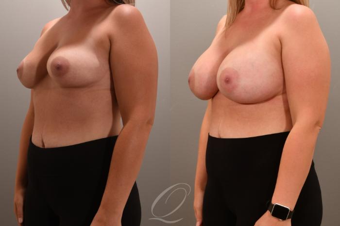 Breast Augmentation Case 1001705 Before & After Left Oblique | Serving Rochester, Syracuse & Buffalo, NY | Quatela Center for Plastic Surgery