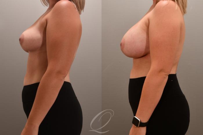 Breast Augmentation Case 1001705 Before & After Left Side | Serving Rochester, Syracuse & Buffalo, NY | Quatela Center for Plastic Surgery