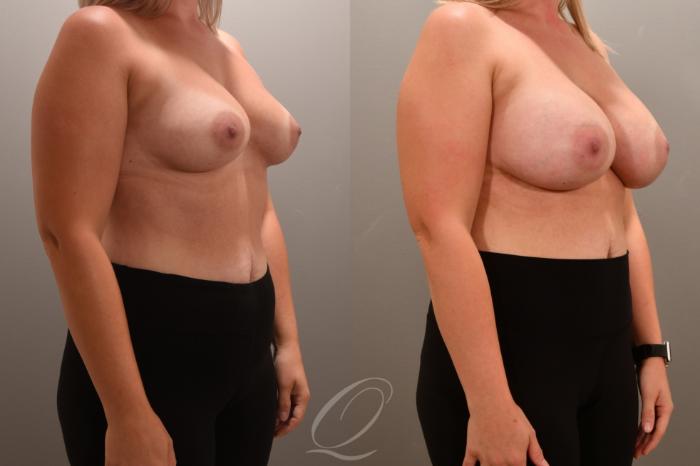 Breast Augmentation Case 1001705 Before & After Right Oblique | Serving Rochester, Syracuse & Buffalo, NY | Quatela Center for Plastic Surgery