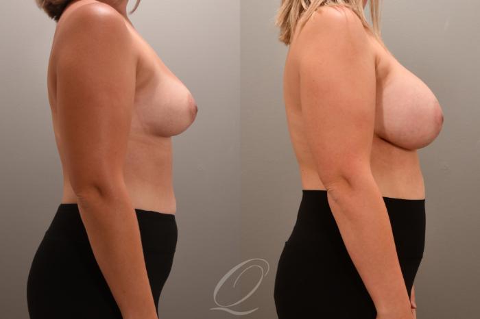 Breast Augmentation Case 1001705 Before & After Right Side | Serving Rochester, Syracuse & Buffalo, NY | Quatela Center for Plastic Surgery