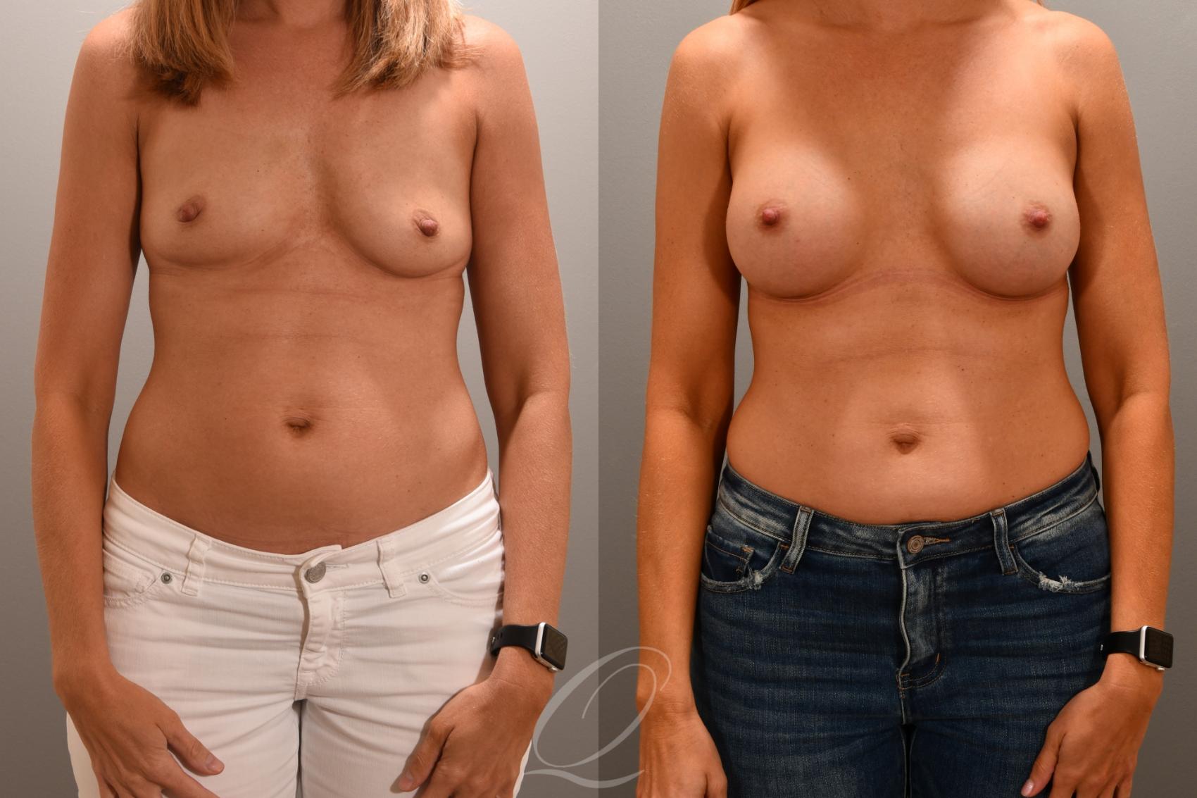 Breast Augmentation Case 1001706 Before & After Front | Serving Rochester, Syracuse & Buffalo, NY | Quatela Center for Plastic Surgery