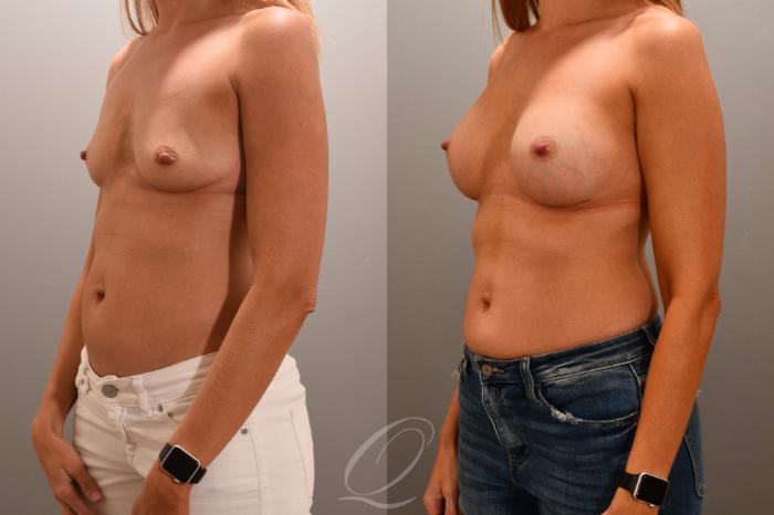 Breast Augmentation Case 1001706 Before & After Left Oblique | Serving Rochester, Syracuse & Buffalo, NY | Quatela Center for Plastic Surgery