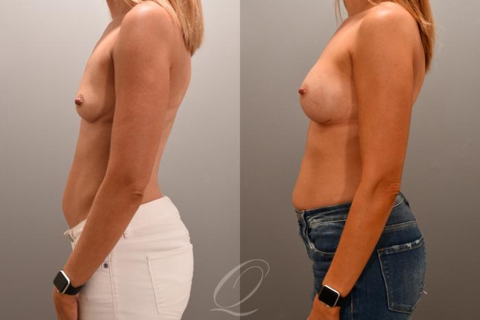 Breast Augmentation Case 1001706 Before & After Left Side | Serving Rochester, Syracuse & Buffalo, NY | Quatela Center for Plastic Surgery