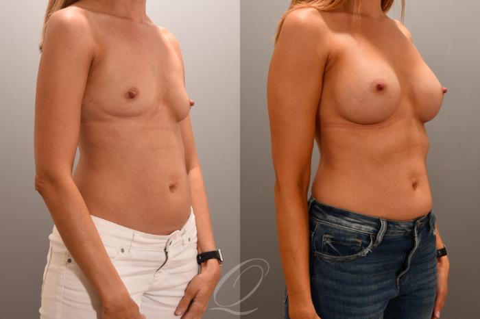 Breast Augmentation Case 1001706 Before & After Right Oblique | Serving Rochester, Syracuse & Buffalo, NY | Quatela Center for Plastic Surgery